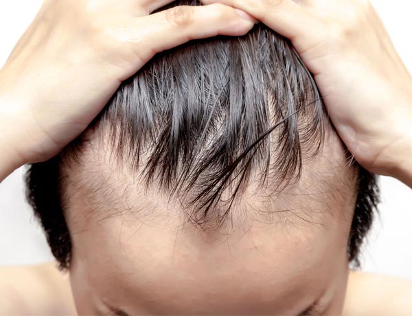 Hair transplant for women
